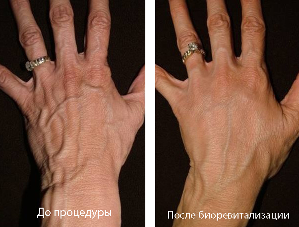 Биоревитализация кистей рук